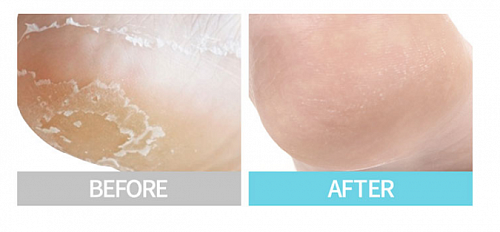 Purederm Пилинг-маска для пяток Exfoliating Heel Mask,18 г Purederm Пилинг-маска для пяток Exfoliating Heel Mask,18 г